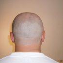 Надежда для лысеющих: Учёные создали прибор, стимулирующий рост волос Надежда для лысеющих: Учёные создали прибор, стимулирующий рост волос
