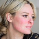 Ученые: Только кофе способен уменьшить розацеа Ученые: Только кофе способен уменьшить розацеа